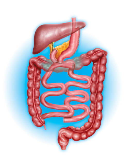 Duodenal Switch