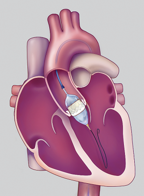 TAVR Illustration