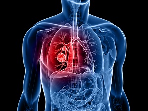 lung cancer screening