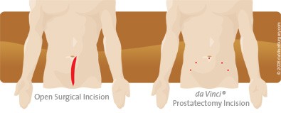 prostatectomy