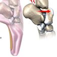 Ankle Impingement Problems