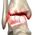 Osteoarthritis Ankle