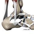 Peroneal Tendon Subluxation