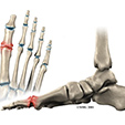 Ankle Impingement Problems