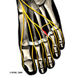 Ankle Syndesmosis Injuries