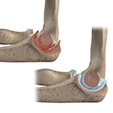 Ankle Impingement Problems