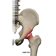 Ankle Sprain Instability