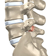 Ankle Sprain Instability