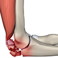 Osteoarthritis Ankle