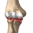 Osteoarthritis Ankle