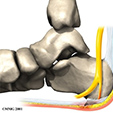 Osteoarthritis Ankle