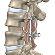 Osteoarthritis Ankle