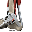 Peroneal Tendon Problems