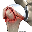 Peroneal Tendon Problems