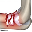 Peroneal Tendon Subluxation