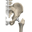 Osteoarthritis Ankle