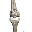 Osteoarthritis Ankle