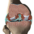 Artificial Joint Ankle