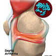 Osteoarthritis Ankle