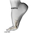 Peroneal Tendon Subluxation