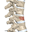 Ankle Impingement Problems