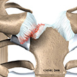 Peroneal Tendon Problems