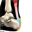 Peroneal Tendon Subluxation