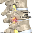 Ankle Sprain Instability