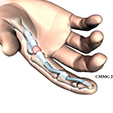 Peroneal Tendon Subluxation