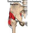 Peroneal Tendon Subluxation