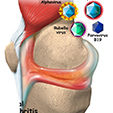 Shin Splints