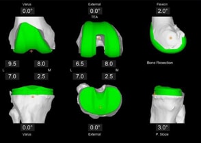 Mako Total Knee 3D Planning