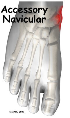 Accessory Navicular Problems	