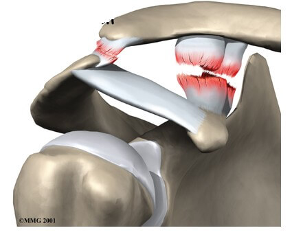 Acromioclavicular Joint Separation	