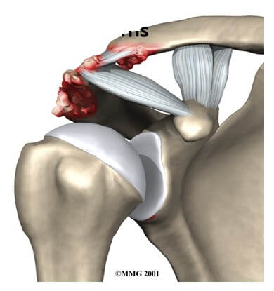 Osteoarthritis of the Acromioclavicular Joint	