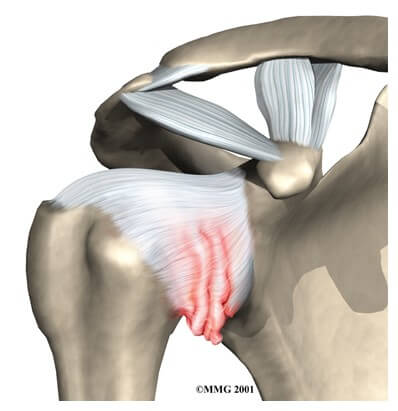 Adhesive Capsulitis	