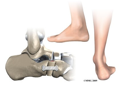 Adult Acquired Flatfoot Deformity	