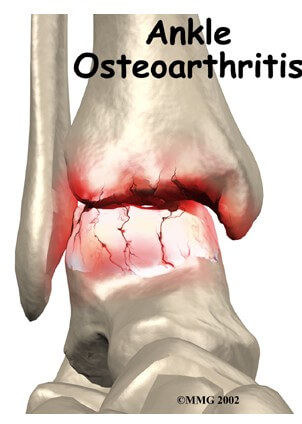 Osteoarthritis of the Ankle	