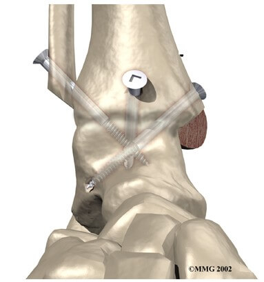 Ankle Fusion	