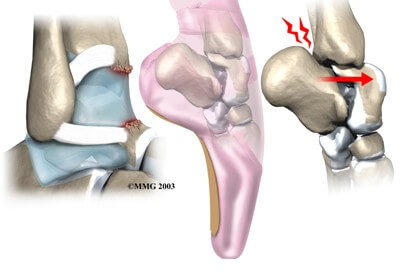 Ankle Impingement Problems	