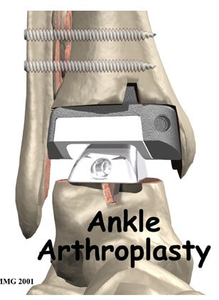 Artificial Joint Replacement of the Ankle	