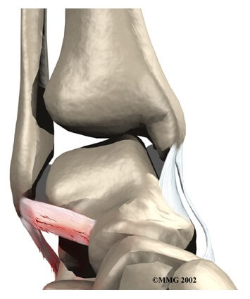 Ankle Sprain and Instability	