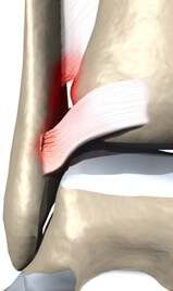 Ankle Syndesmosis Injuries	