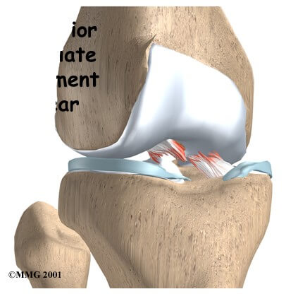 Anterior Cruciate Ligament Injuries (ACL)