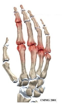 Arthritis of the Finger Joints	