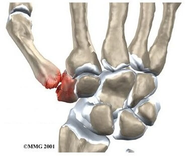 Arthritis of the Thumb	