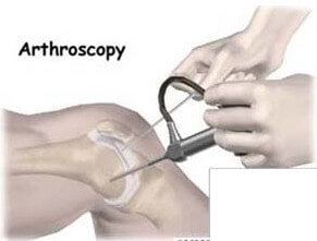 Arthroscopy