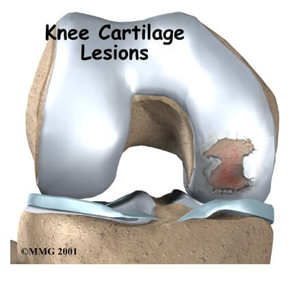 Articular Cartilage Problems	