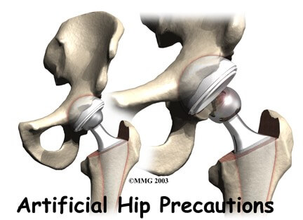 Artificial Hip Dislocation Precautions	