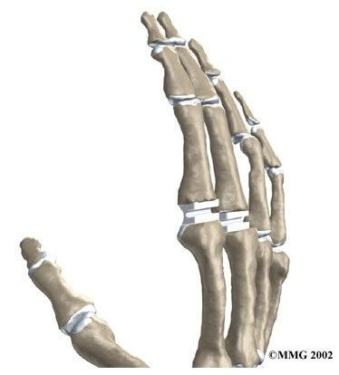 Artificial Joint Replacement of the Finger	